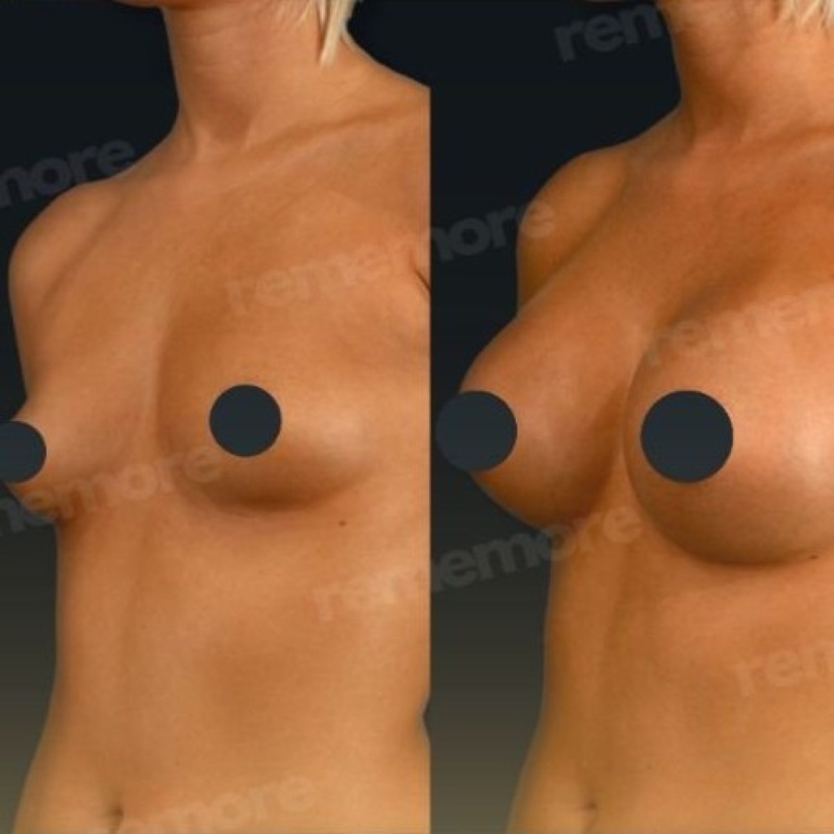 Before and after breast implants with lift at Memorial Bahçelievler Hospital, enhanced shape result