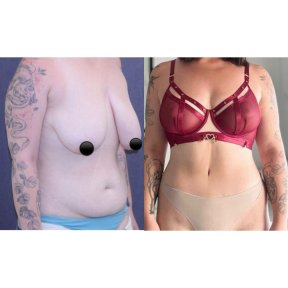 Breast Reduction