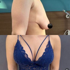 Breast Reduction - photo 3