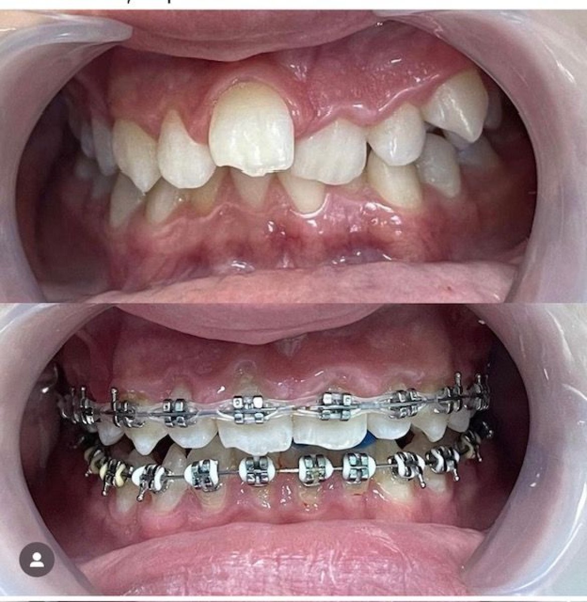 Avant-après appareil dentaire adulte à VerMax Dental Clinic, amélioration de l’alignement
