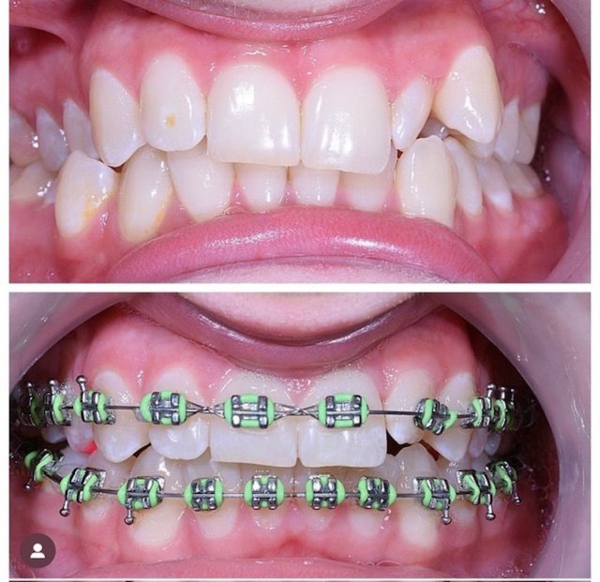 Before and after adult braces treatment at VerMax Dental Clinic, visible teeth alignment result