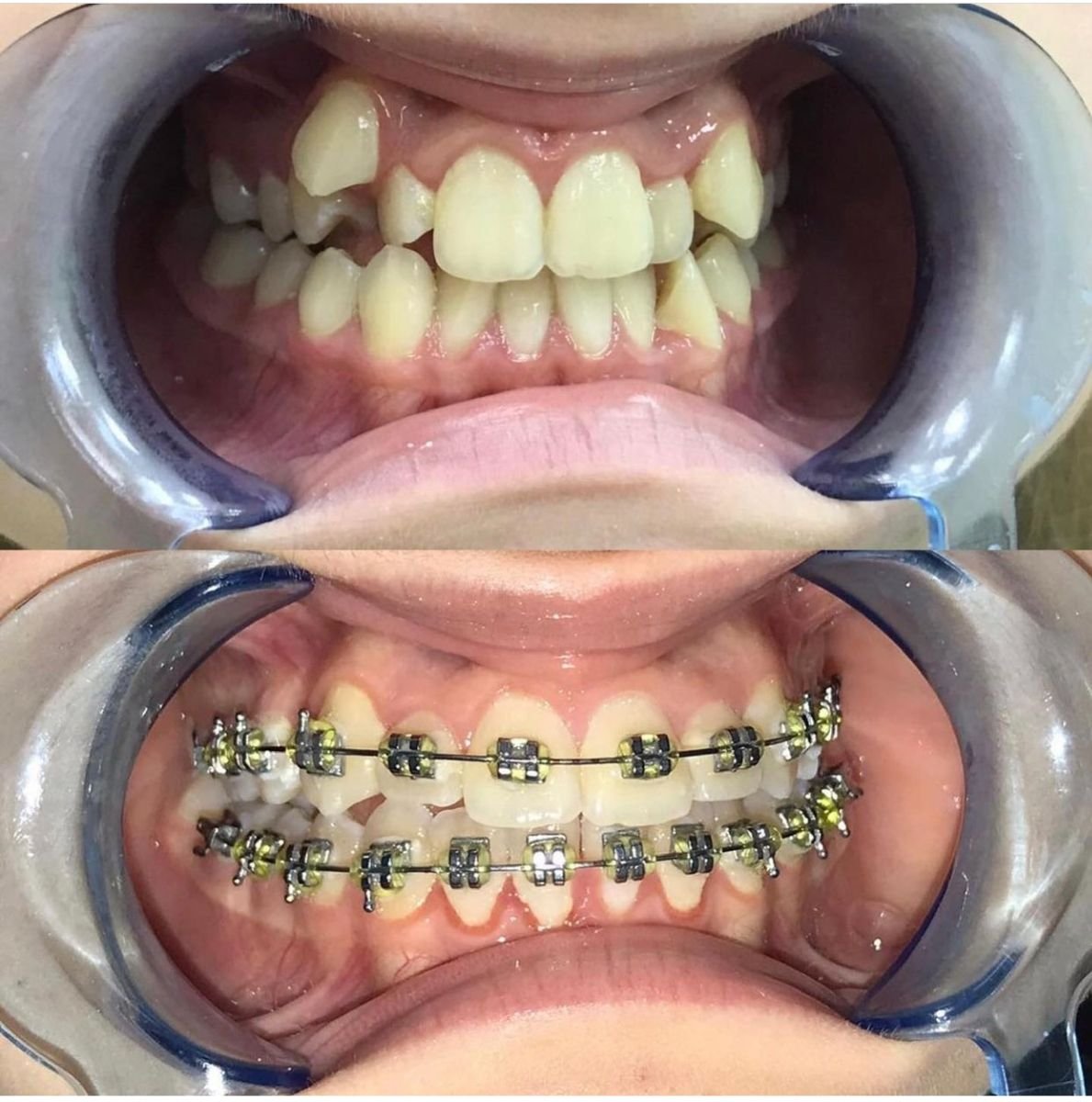 Résultats avant et après appareil dentaire adulte à VerMax Dental Clinic, alignement des dents