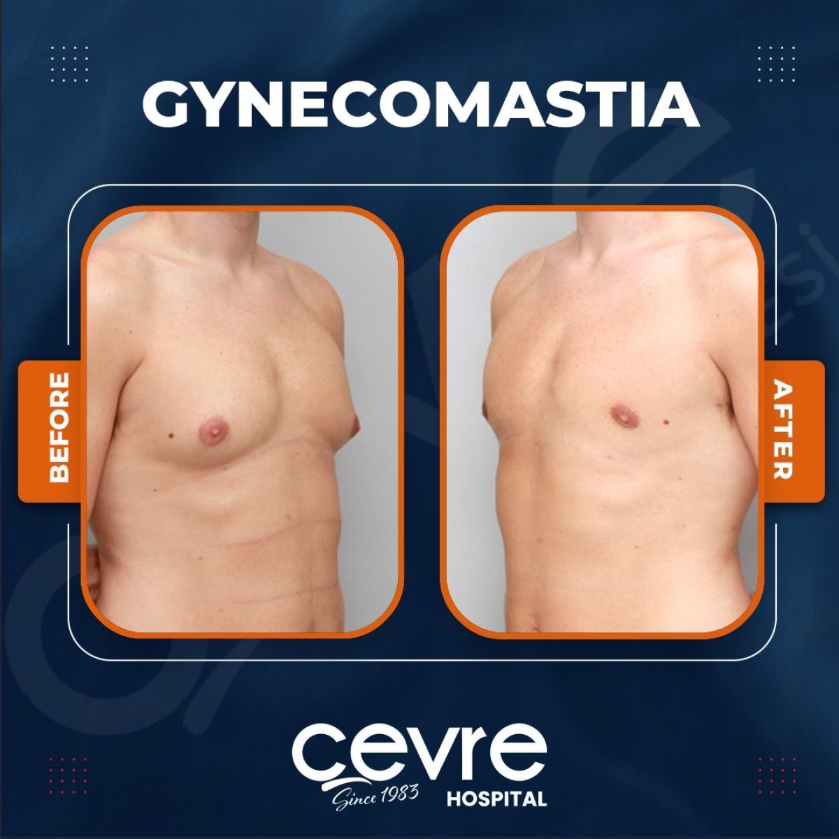 Before and after gynecomastia surgery results at Adem and Havva Medical Center, chest contour