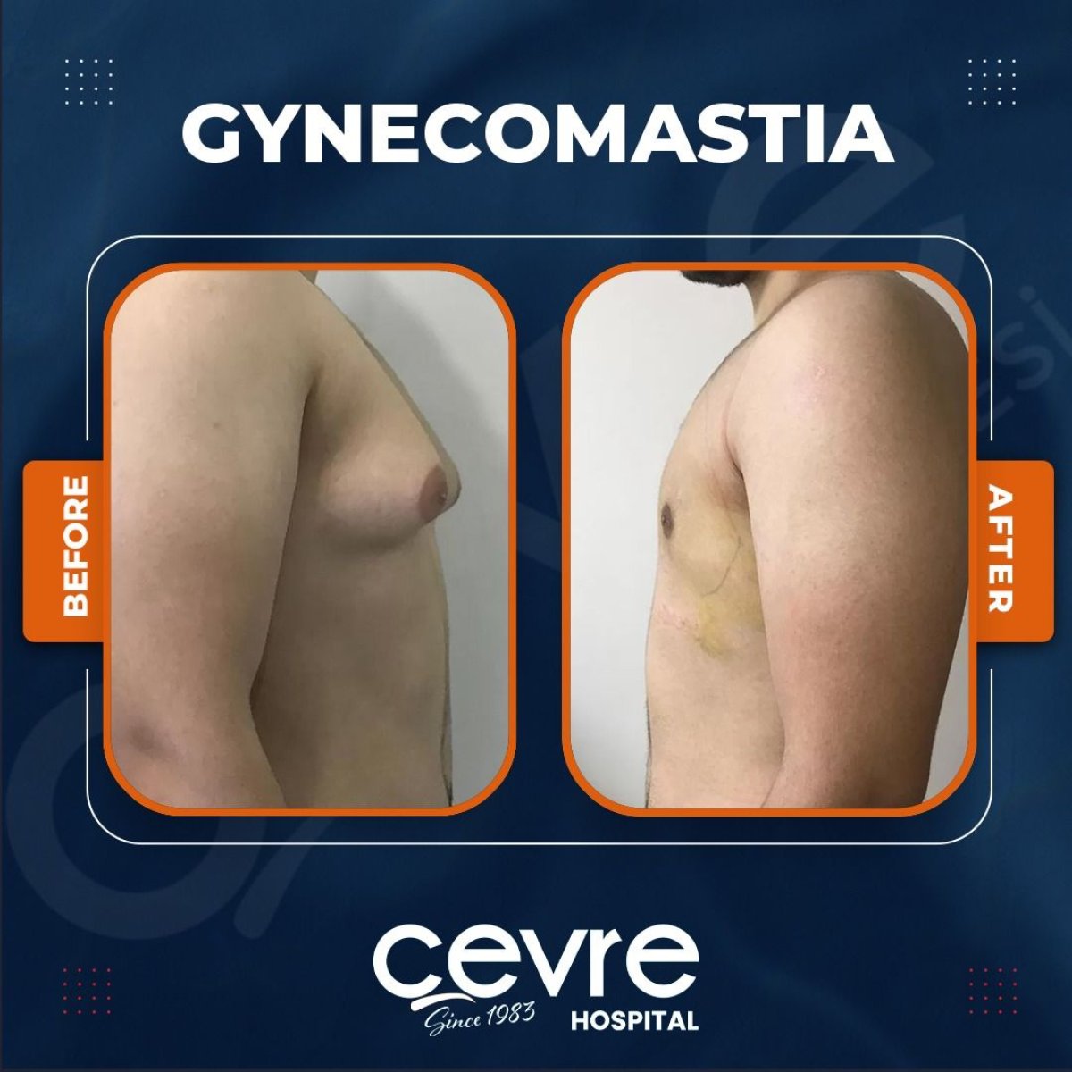 Résultats avant/après gynécomastie à Adem and Havva Medical Center, contour du torse
