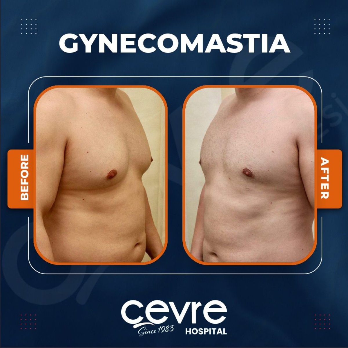 Résultats avant et après gynécomastie à Adem and Havva Medical Center, contour du torse