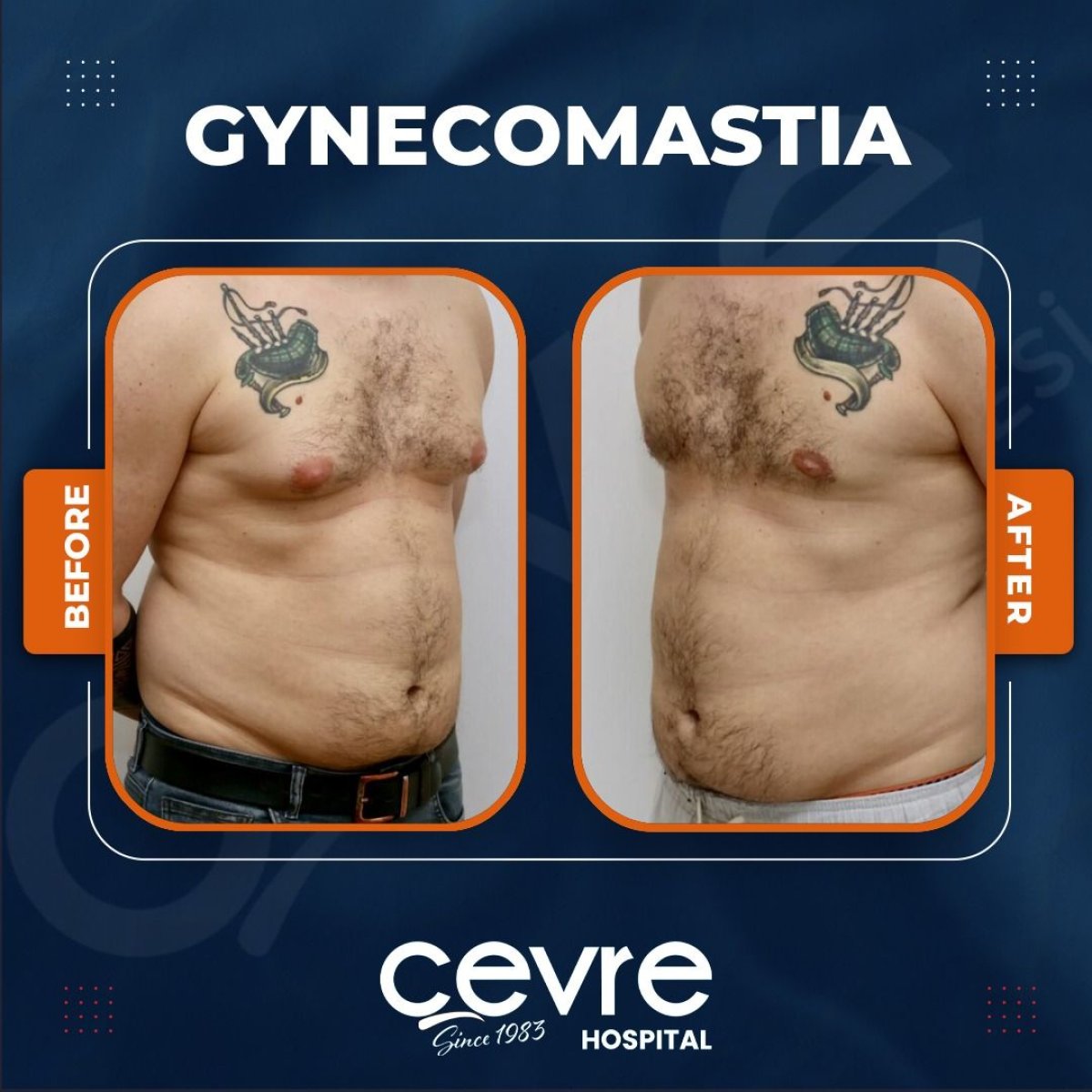 Before and after gynecomastia surgery results at Adem and Havva Medical Center, chest contour