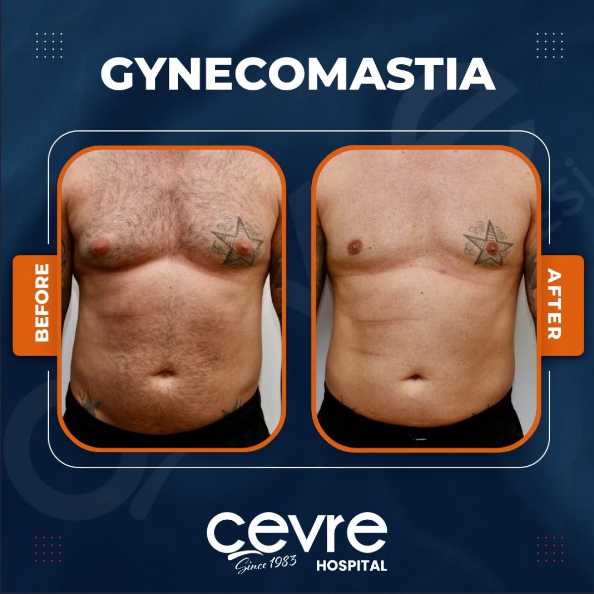 Resultados antes y después de cirugía de ginecomastia en Adem and Havva Medical Center, contorno