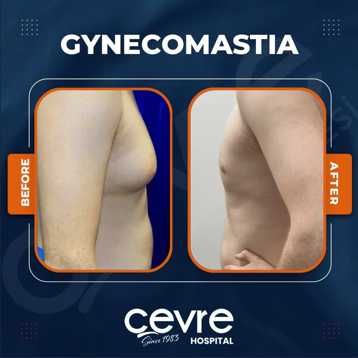 Gynecomastia surgery before and after results at Adem and Havva Medical Center, chest contour