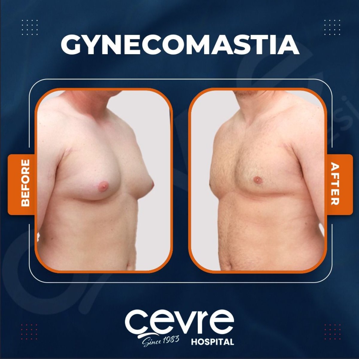 Resultados antes y después de ginecomastia en Adem and Havva Medical Center, contorno de pecho