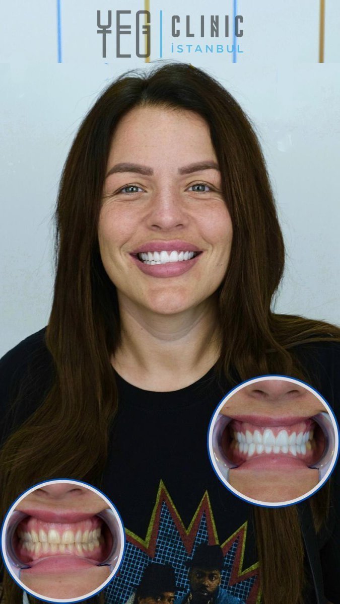 Porcelain crown installation before and after results at YEG Clinic, smile makeover visible