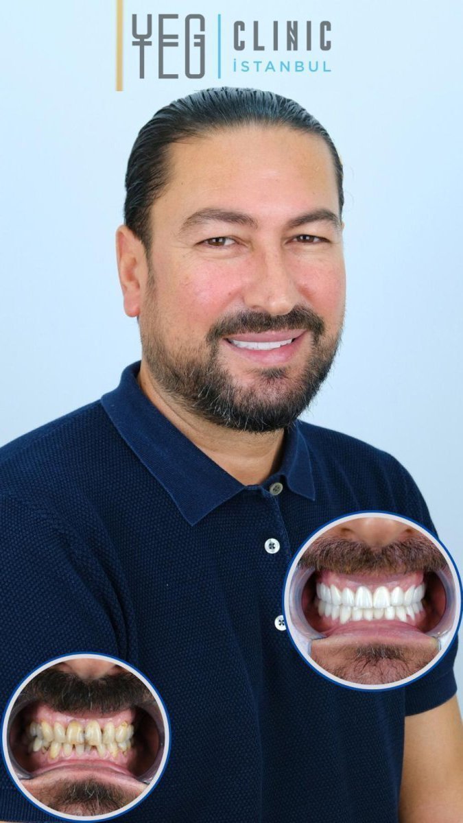 Porcelain crown installation before and after results at YEG Clinic, improved smile aesthetics