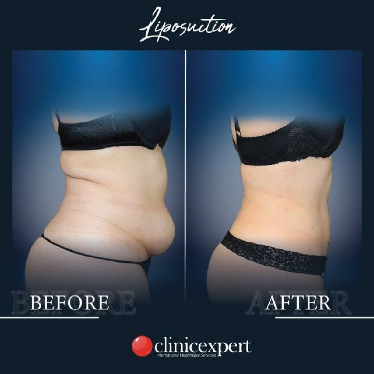 Before and after liposuction results at CE International Hospital, visible body contouring