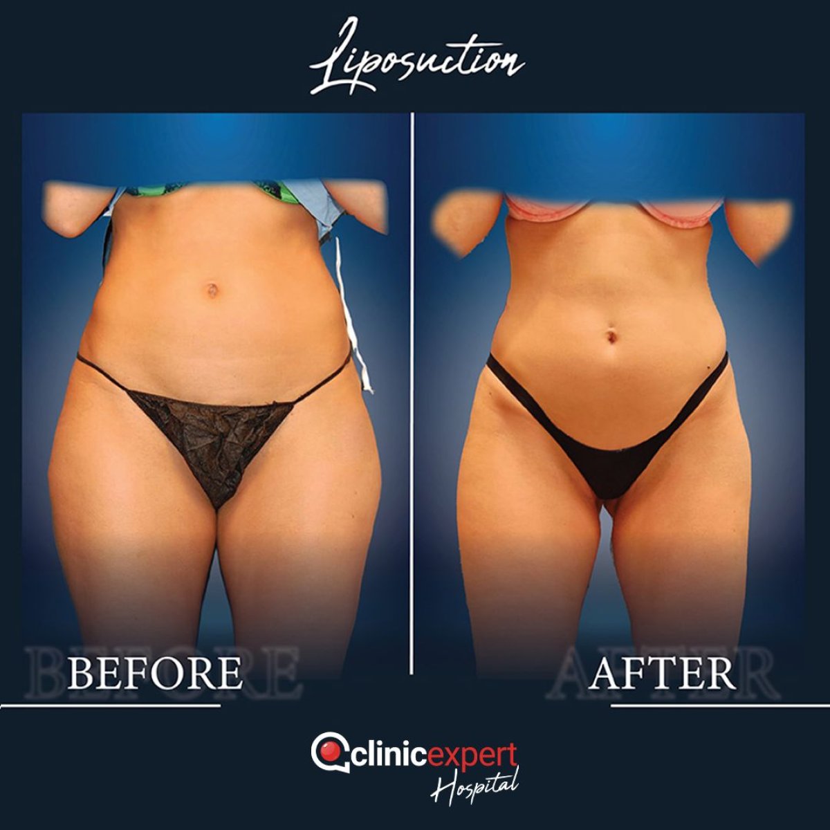 Efekty liposukcji przed i po w CE International Hospital, widoczne modelowanie sylwetki