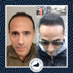 DHI Hair Transplantation | Package price