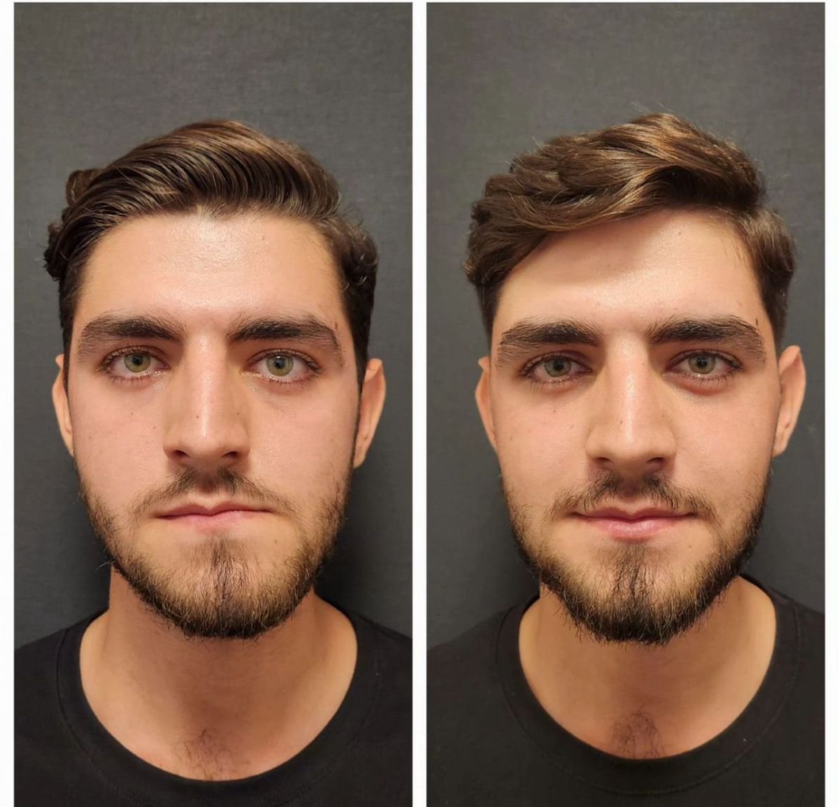 Resultados antes y después de genioplastia deslizante en Memorial Bahçelievler Hospital, contorno de mentón