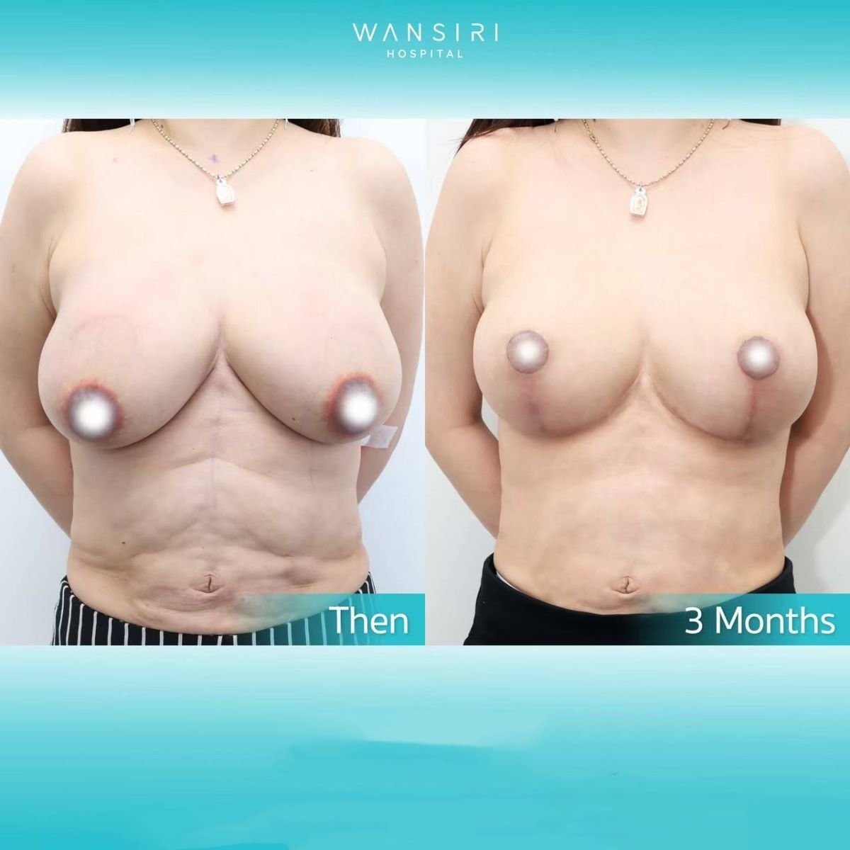 Before and after breast lift results at Wansiri Hospital, improved breast shape in 3 months