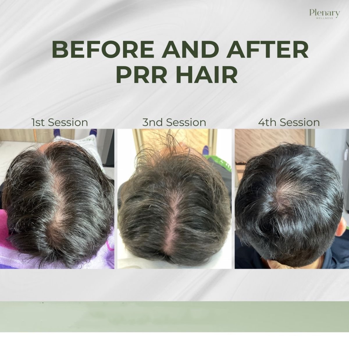Before and after PRP hair loss treatment results at Plenary Wellness, visible hair regrowth