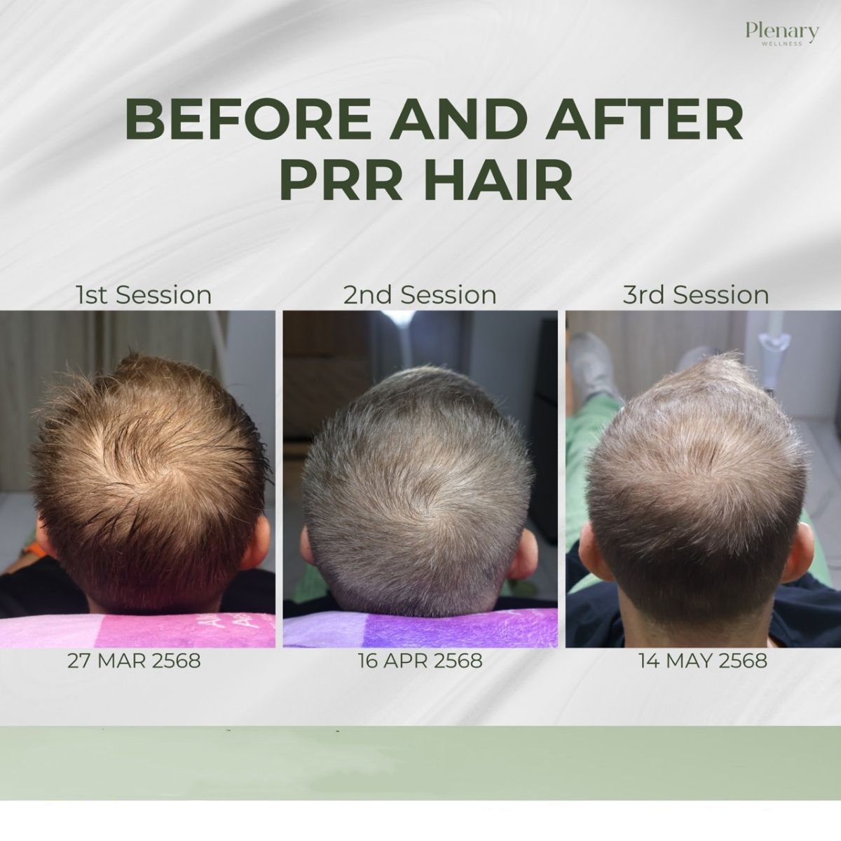 Before and after PRP hair loss treatment at Plenary Wellness – visible hair density improvement