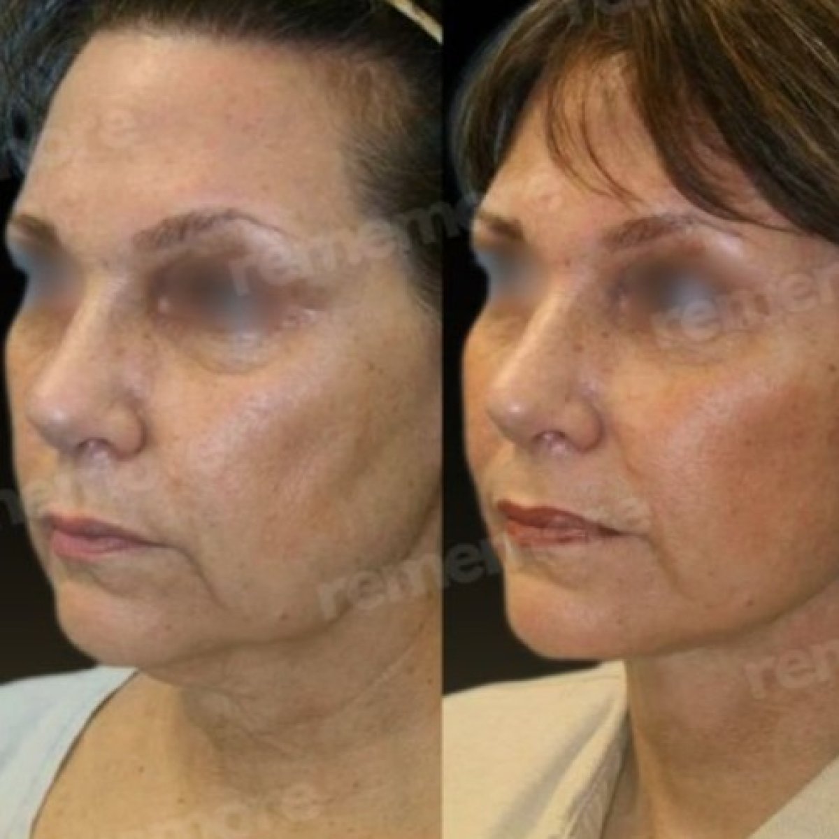 Before and after neck lift results at Memorial Şişli Hospital, visible jawline improvement