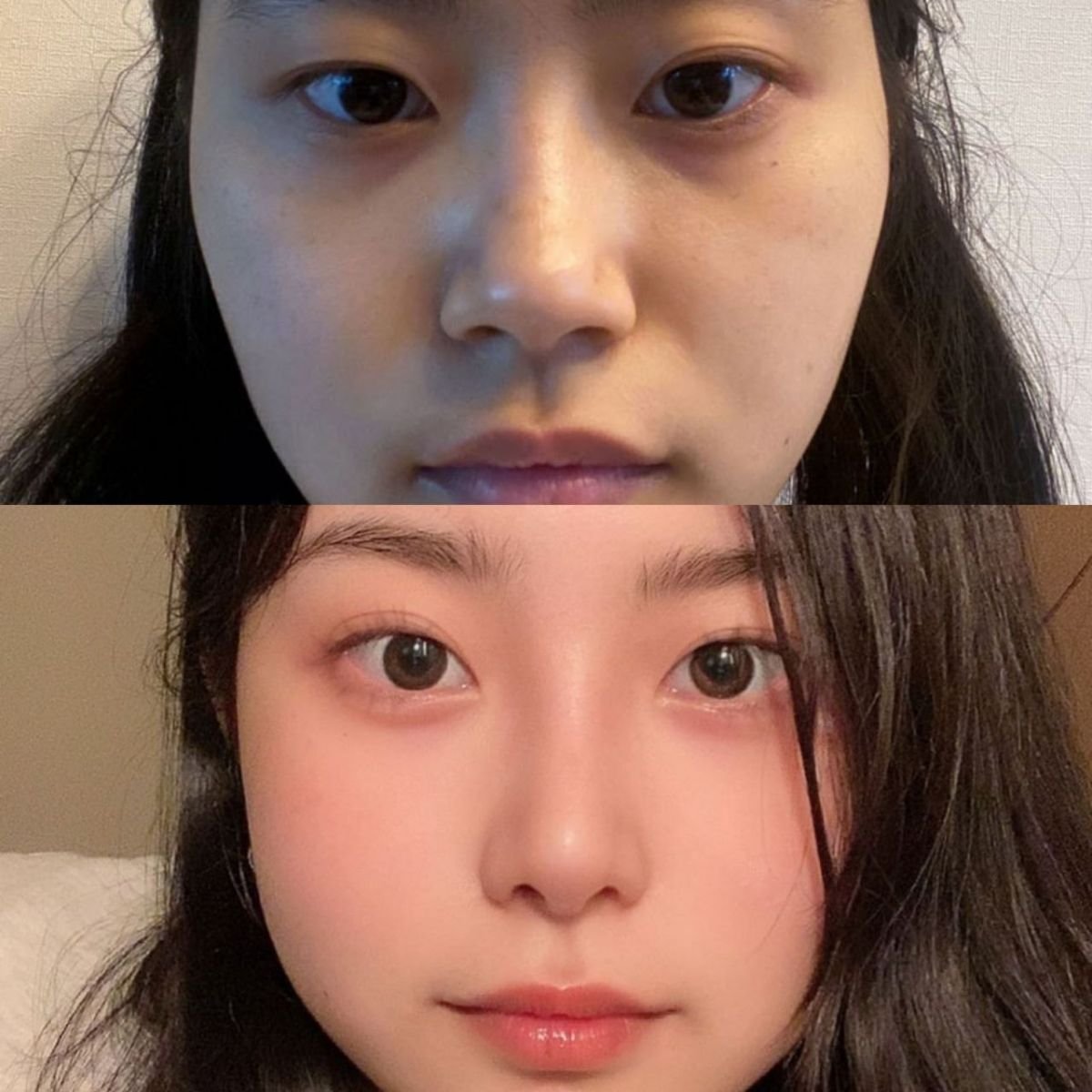 نتائج قبل وبعد عملية تصغير فتحات الأنف في VG Plastic Surgery، تحسين شكل الأنف