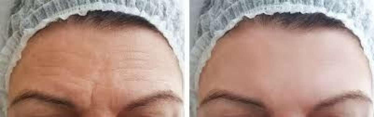 Reducción de arrugas en la frente antes y después de botox en Odontoliuzzi Dentistry and Health
