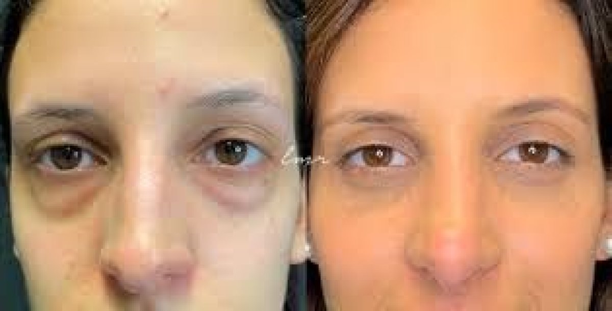 Resultados de blefaroplastia antes y después en Odontoliuzzi Dentistry and Health, corrección de párpados