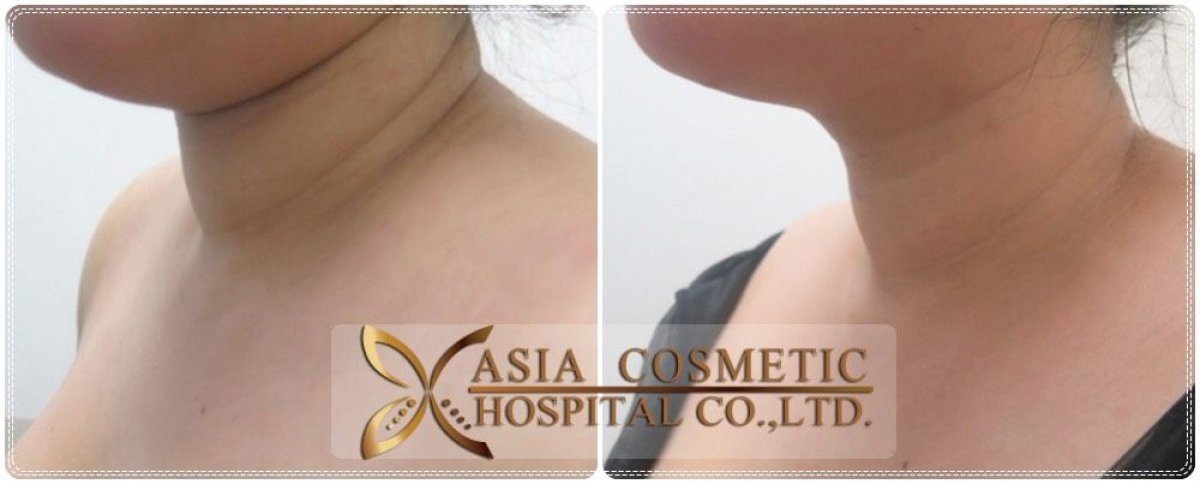 نتائج شفط دهون الذقن قبل وبعد في Asia Cosmetic Hospital، تحديد الفك المحسن