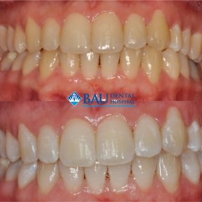 SPECIAL TEETH WHITENING PACKAGE