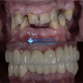 Standard 8 E-max Veneers All Included