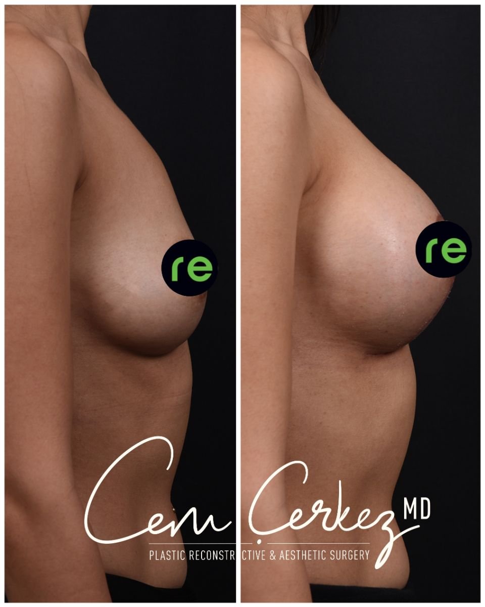 Before and after breast implants with lift results at RENOVIUM CLINIC BY CEM CERKEZ MD