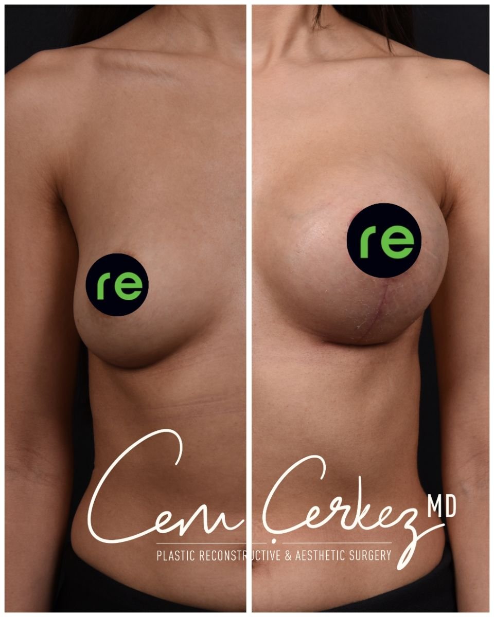 Resultados antes y después de implantes y lifting de senos en RENOVIUM CLINIC BY CEM CERKEZ MD