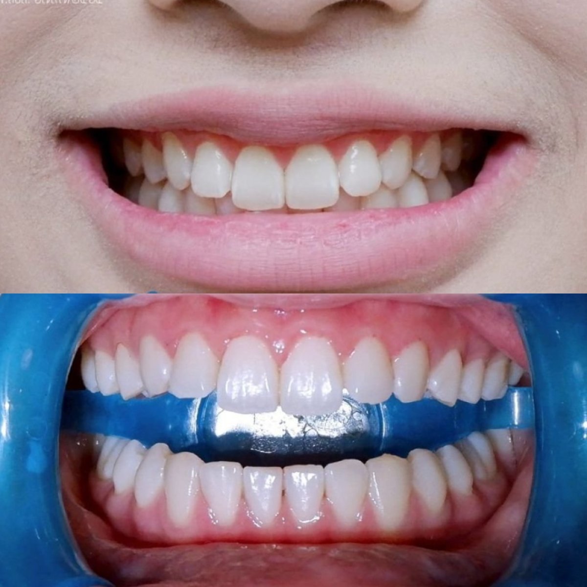Resultados antes y después de limpieza dental (scaling) en Deezy Dental Home, dientes más limpios
