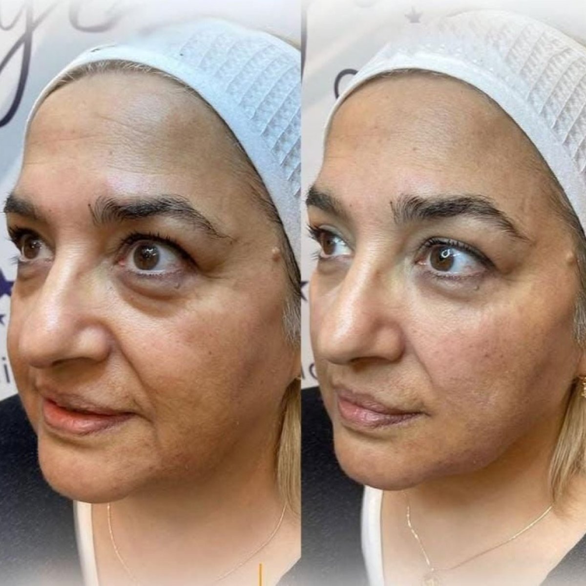 نتائج شد البشرة Morpheus8 قبل وبعد في Adem and Havva Medical Center، بشرة أكثر نعومة