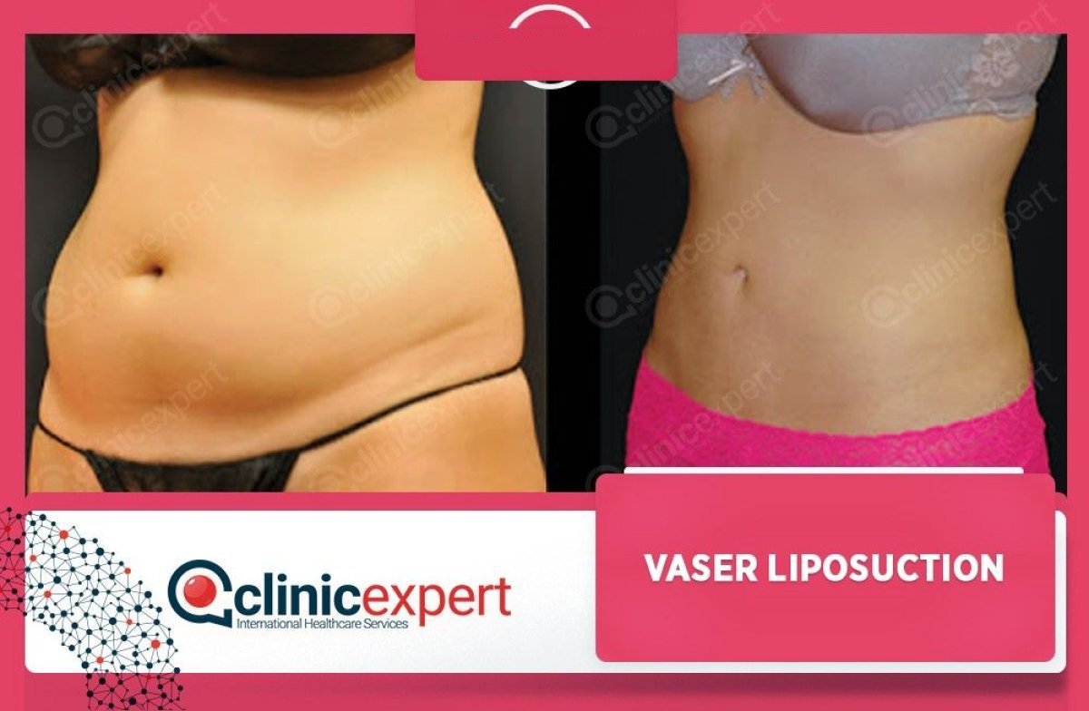 Efekty przed i po liposukcji VASER w CE International Hospital, szczuplejszy brzuch