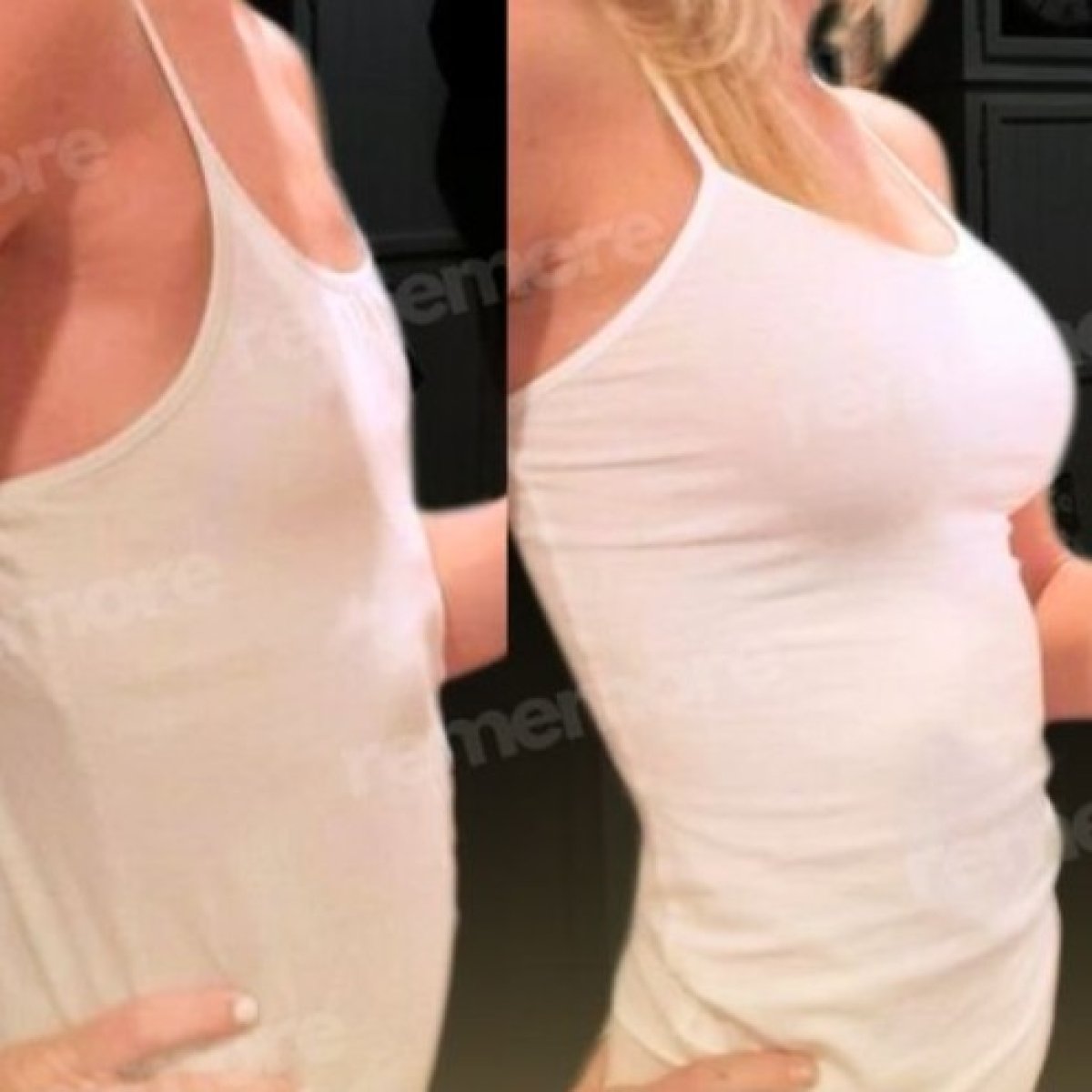 Before and after mammoplasty results at Memorial Şişli Hospital, visible breast enhancement