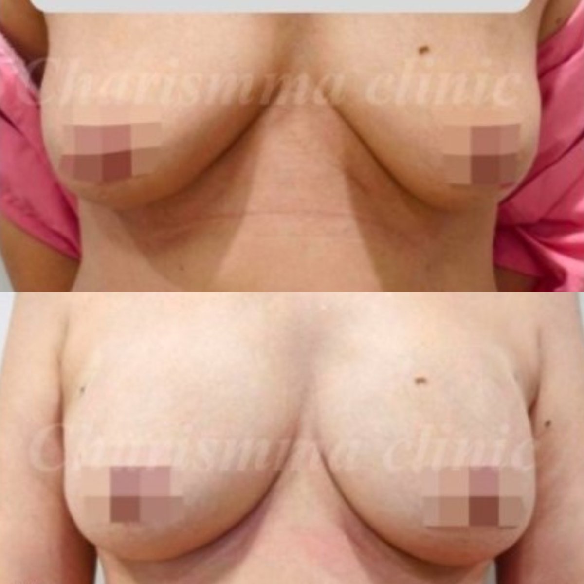 Before and after breast augmentation results at Charismma Clinic, enhanced breast shape