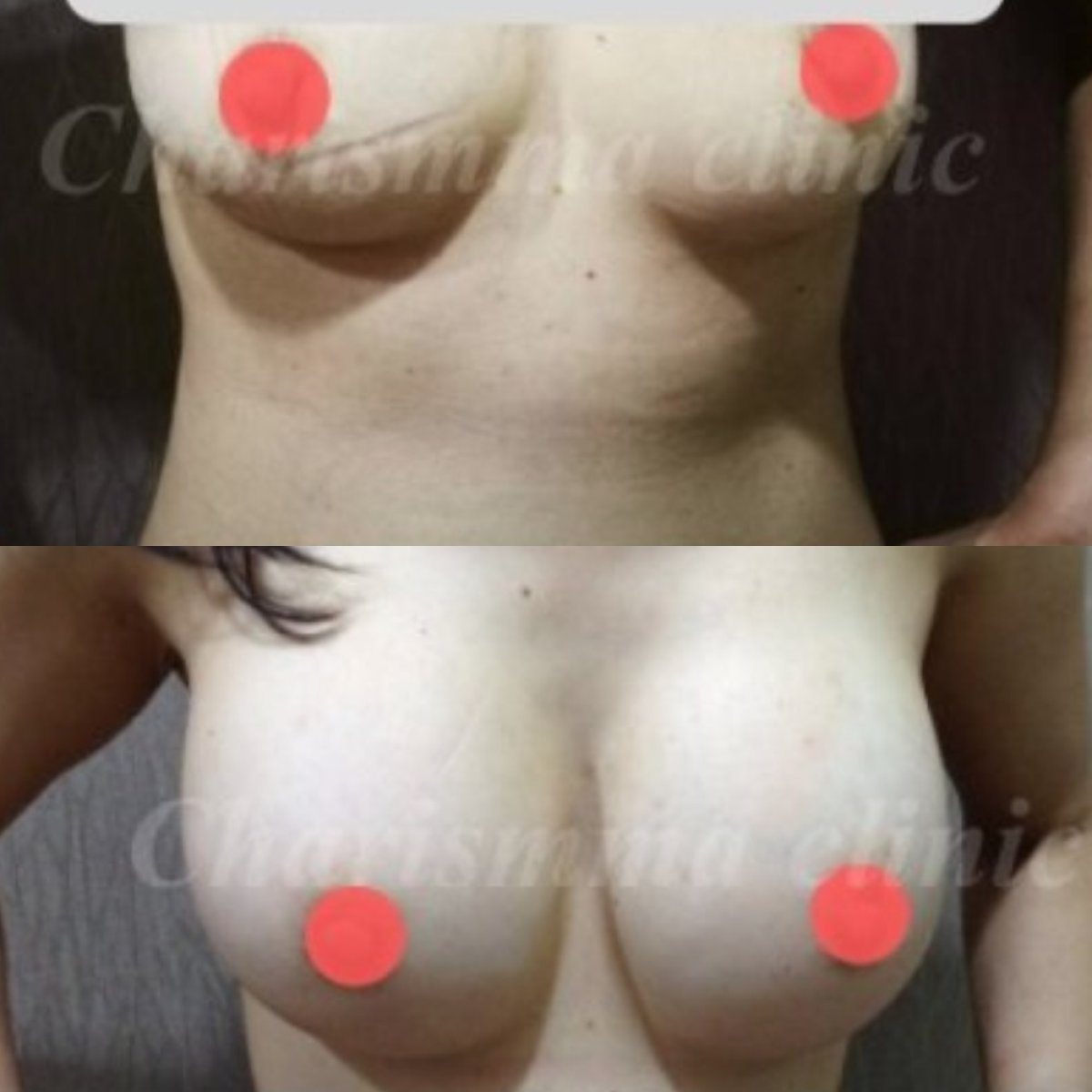 Résultats avant/après augmentation mammaire par lipofilling à la Charismma Clinic