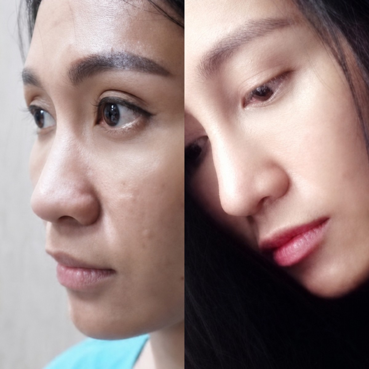 نتائج عملية تجميل الأنف قبل وبعد في Charismma Clinic، إعادة تشكيل الأنف بشكل طبيعي