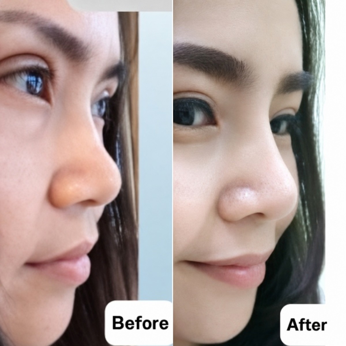 نتائج عملية تجميل الأنف قبل وبعد في Charismma Clinic، إعادة تشكيل طبيعية للأنف