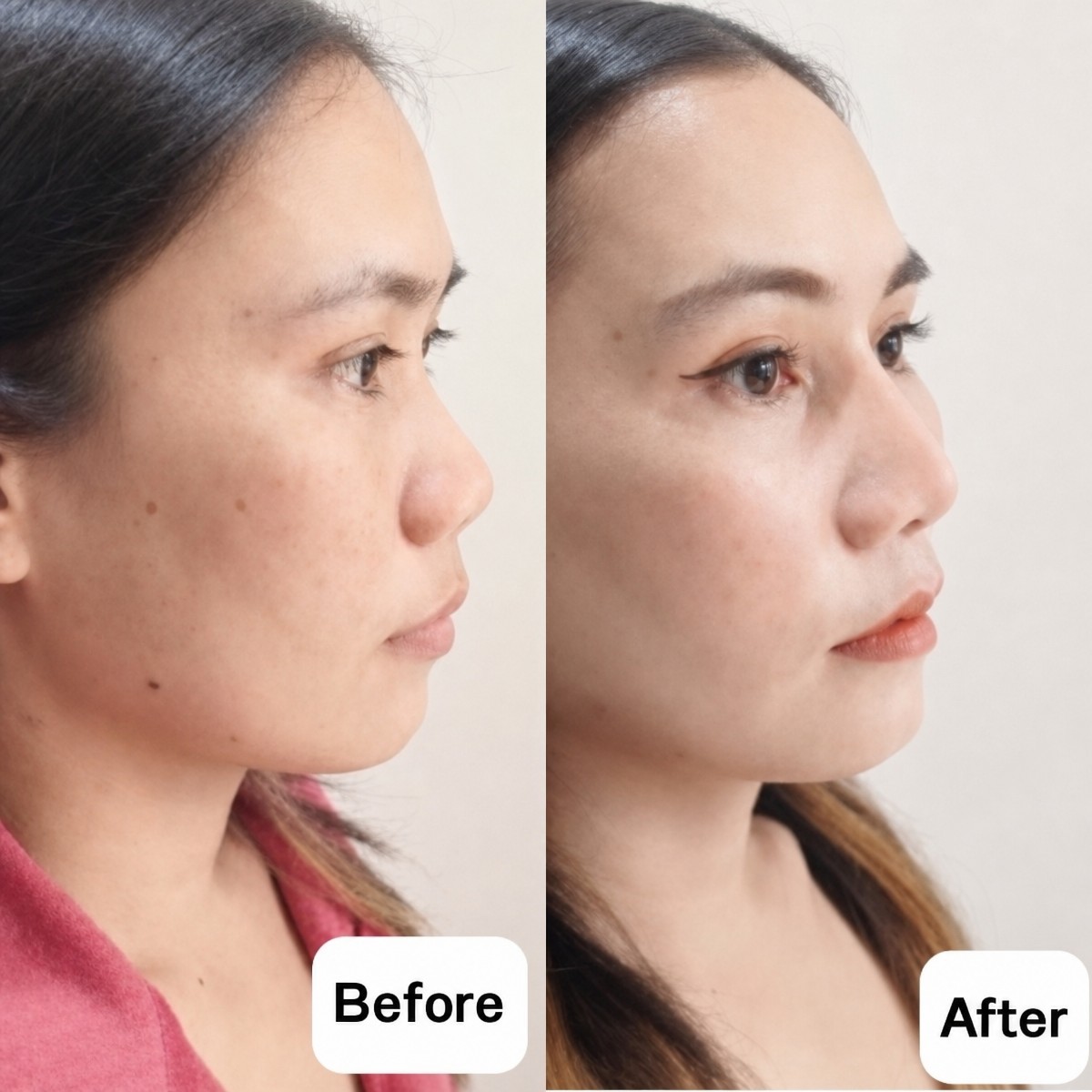 نتائج تجميل الأنف قبل وبعد في Charismma Clinic، تحسين شكل الأنف والملامح