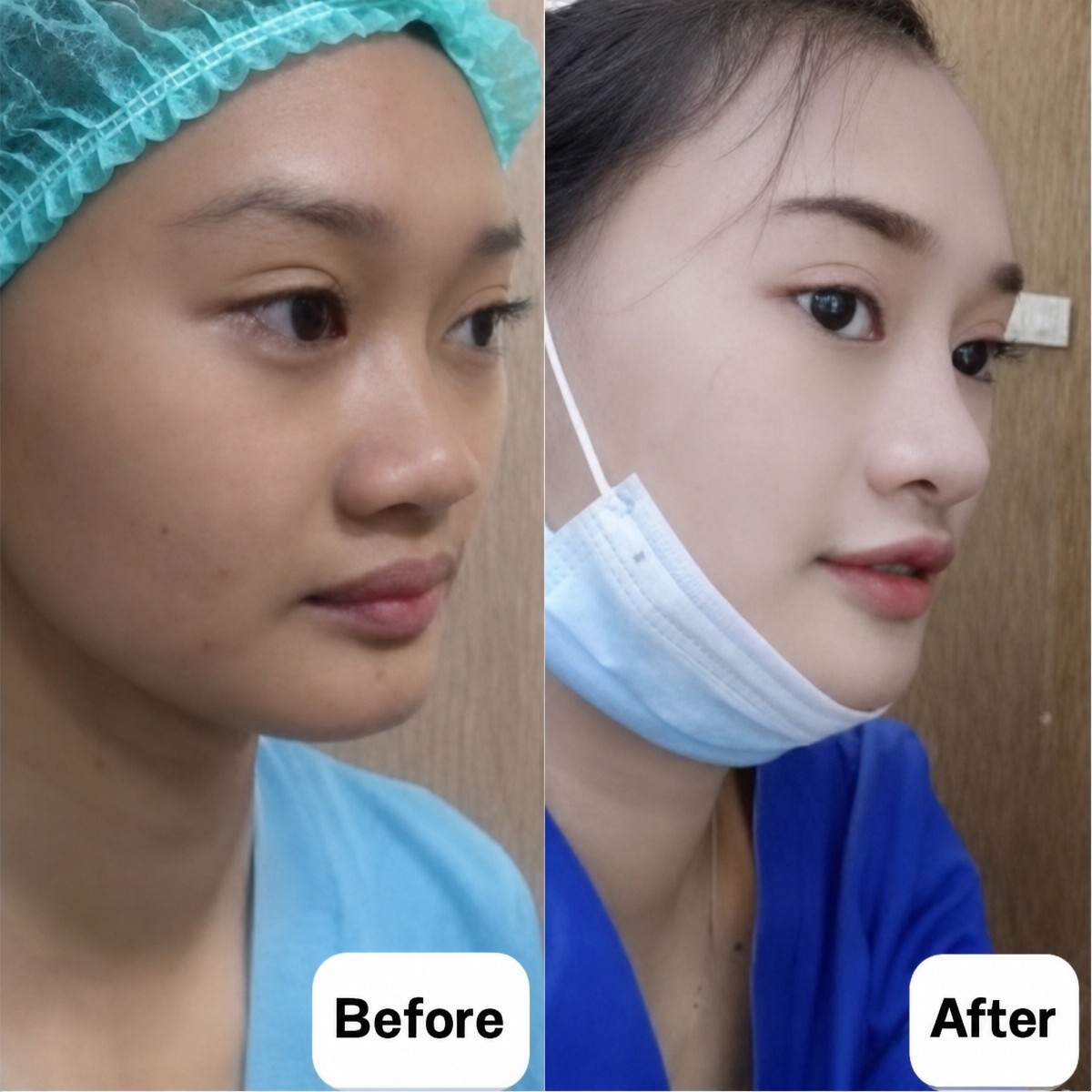 نتائج عملية تجميل الأنف قبل وبعد في Charismma Clinic، تحسين شكل الأنف والملف الجانبي