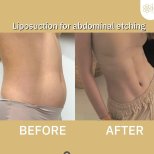 Before and after Вазер (Vaser) липосакция photos by Dr. Dr Phatcharasak Kraisornphongsakul Md