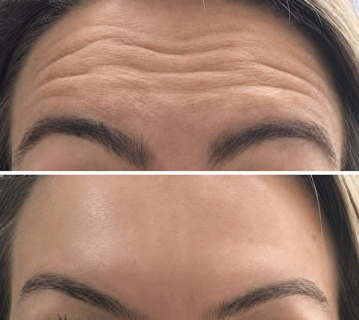 Antes y después de inyecciones de bótox en Odontoliuzzi Dentistry and Health, frente más lisa