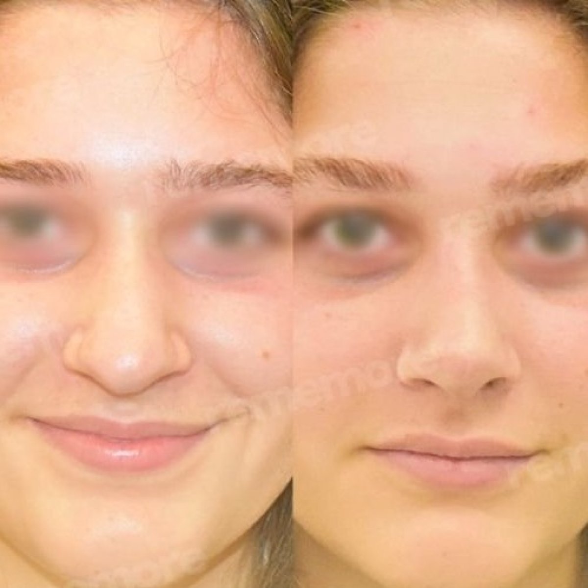 نتائج عملية تجميل الأنف قبل وبعد في مستشفى ميموريال أنقرة، إعادة تشكيل الأنف