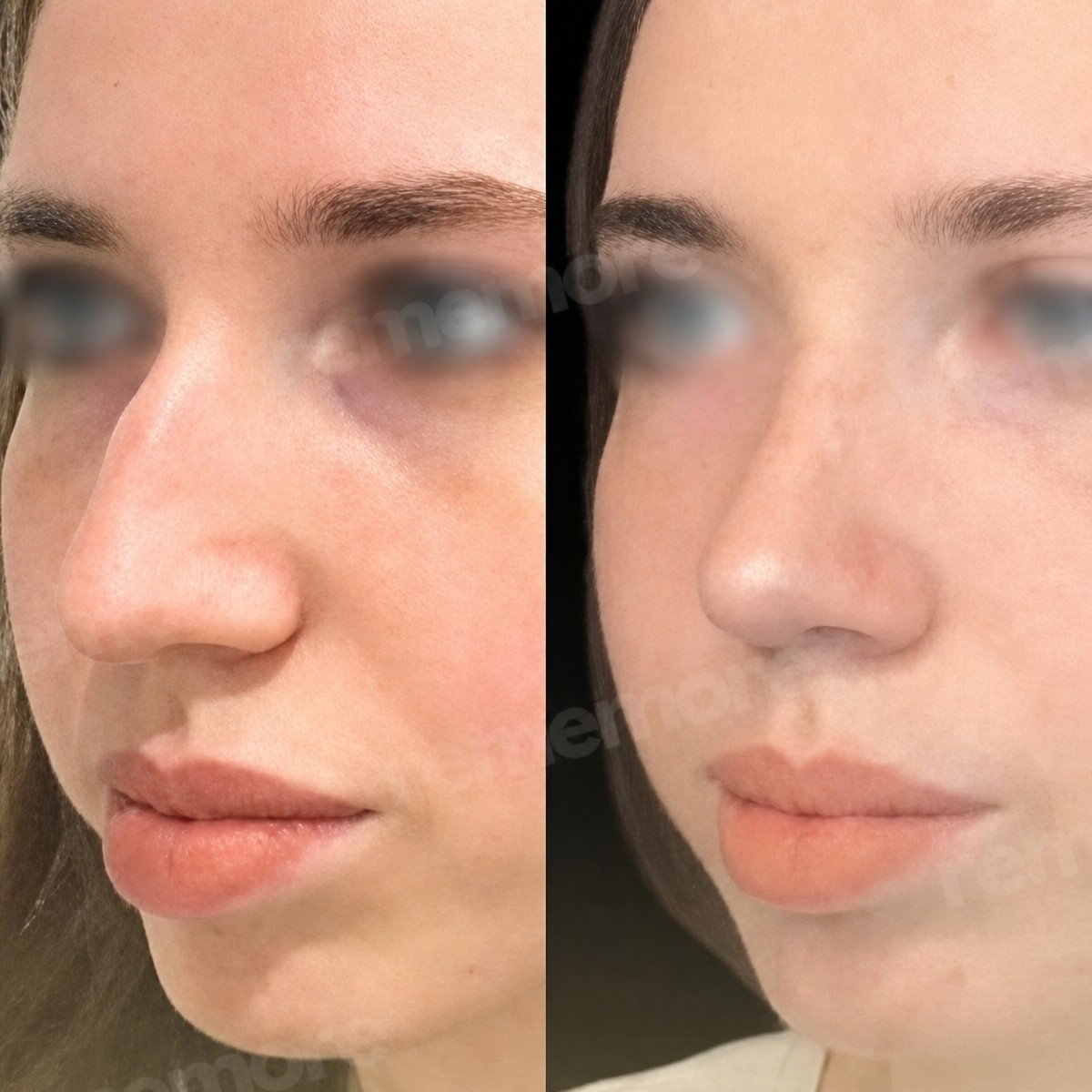 نتائج عملية تجميل الأنف قبل وبعد في مستشفى ميموريال أنقرة، تحسين شكل الأنف