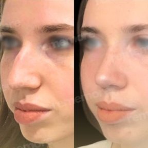 Rhinoplasty (nose job) - photo 4