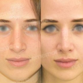 Rhinoplasty (nose job) - photo 5