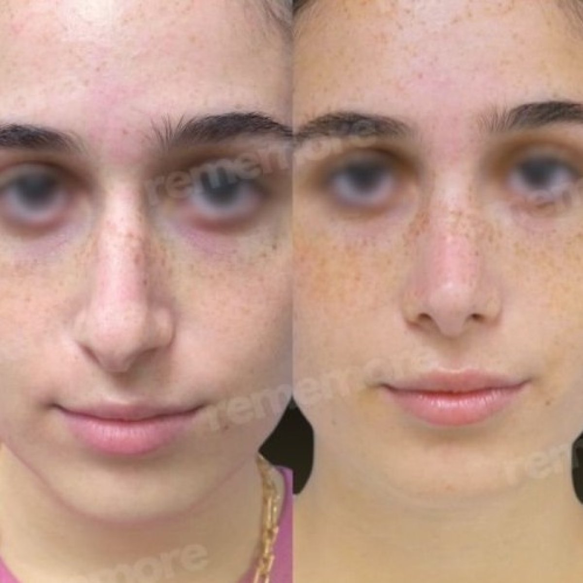نتائج عملية تجميل الأنف قبل وبعد في مستشفى ميموريال أنقرة، تحسين شكل الأنف