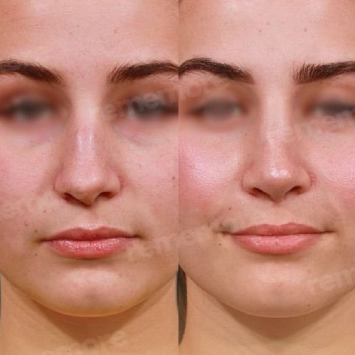 Résultats avant et après rhinoplastie à Memorial Ankara Hospital, amélioration du nez
