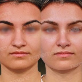 Rhinoplasty (nose job) - photo 6